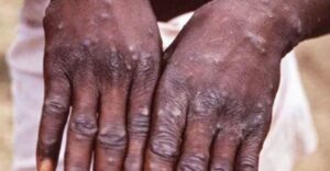 monkeypox